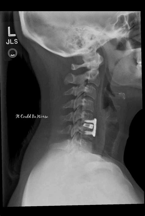 ACDF Surgery – 3 Weeks Post-Op & X-rays