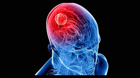 Al año, diagnostican 300 mil nuevos casos de tumores cerebrales en el mundo