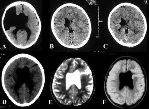 Schizencephaly. (A) Patient with Rt sided open lip schizencephaly. (B... | Download Scientific ...