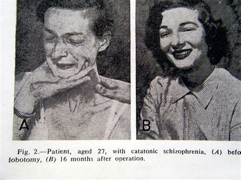 Before-After-Lobotomy-Surgery-Patients-Photos | Insane asylum patients, Human species, Lobotomy