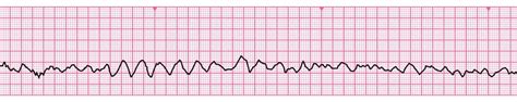 Life expectancy atrial fibrillation: Atrial Fibrillation: Prognosis ...