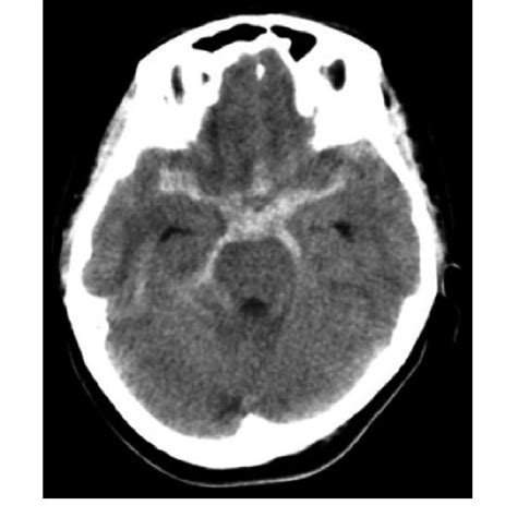 Figure. T2-weighted MRI reveals hyperintensity in basilar cistern,... | Download Scientific Diagram