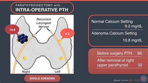 Intraoperative Parathyroid Hormone (PTH) Testing | Dr. Larian