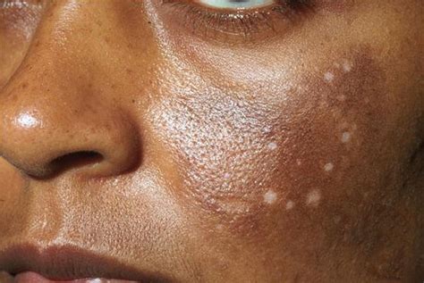 Hyperpigmentation: How to Properly Treat and Prevent It for Glowing Skin