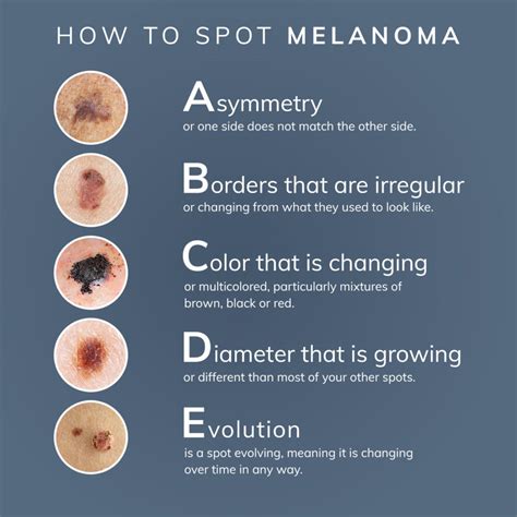 Melanoma: What You Need to Know - DermPhysicians of New England