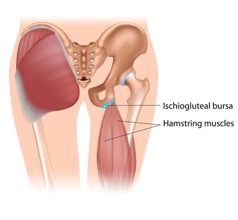 Ischial Bursitis - Upswing Health | Upswing Health