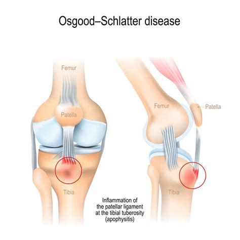 Understanding Osgood-Schlatter Disease I Orthopaedic Specialty Group