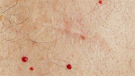 Common Skin Lesions - vrogue.co