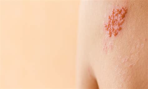 Shingles is more than a rash