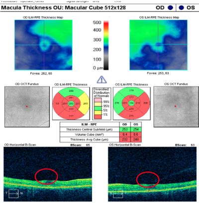 Dr. Noskow's Case Report | Plaquenil Toxicity - Hollywood Eye Institute