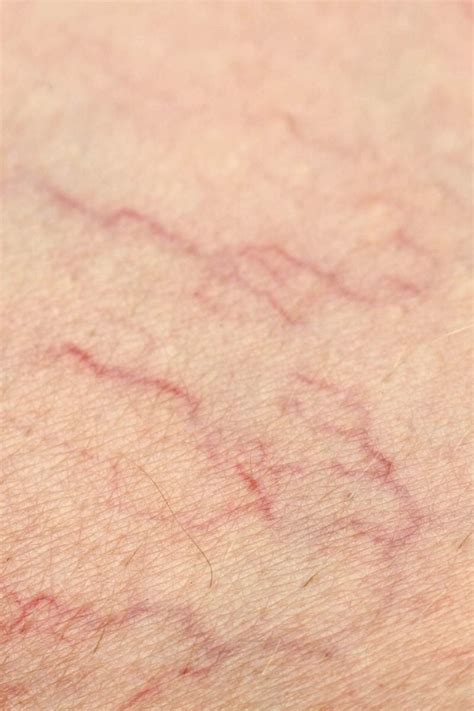 Telangiectasia: Causes, diagnosis, and treatment