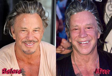 Mickey Rourke Plastic Surgery: Is It Enough?