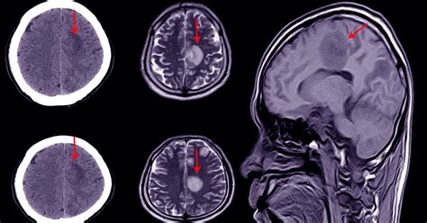 Anoxia frente a hipoxia: diferencias entre lesiones cerebrales