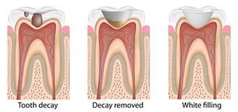 Difference Between A Dental Filling And A Dental Crown | Dentist Redondo Beach