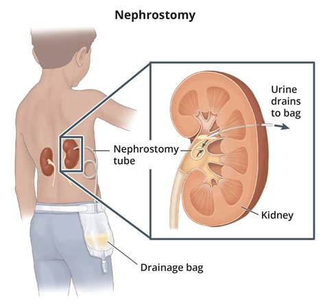 Ostomy Surgery: Ileostomy & Colostomy | General Surgery