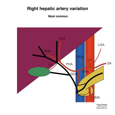 Variant hepatic arterial anatomy | Radiology Reference Article ...