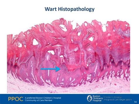 [DIAGRAM] Diagram Of Elbow Wart - MYDIAGRAM.ONLINE