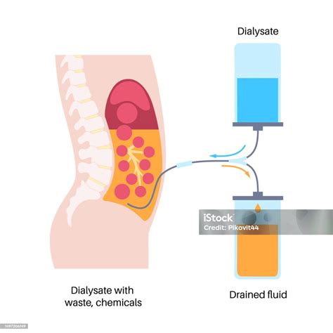 Peritoneal Dialysis Concept Stock Illustration - Download Image Now ...