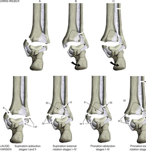 Ankle Fractures: Open Reduction Internal Fixation | Musculoskeletal Key