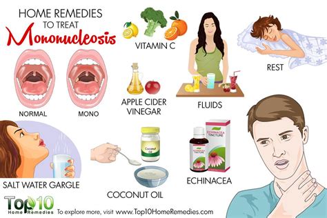 Symptoms Of Mononucleosis Include