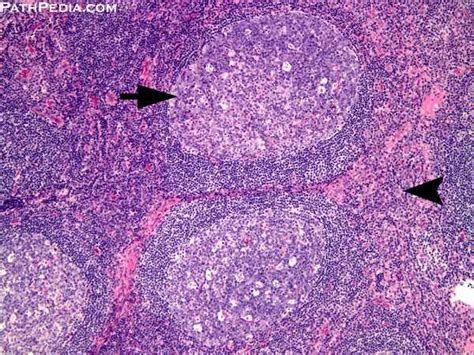 Histology images of Lymph node by PathPedia.com: Pathology e-Atlas