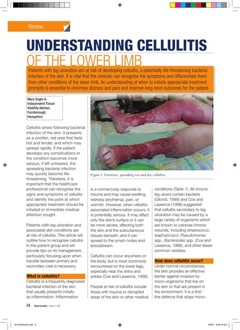 Cellulitis Treatment