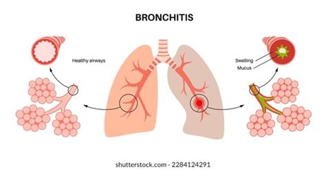 Bronchitis Concept Infection Lungs Bronchi Anatomical Stock Vector ...