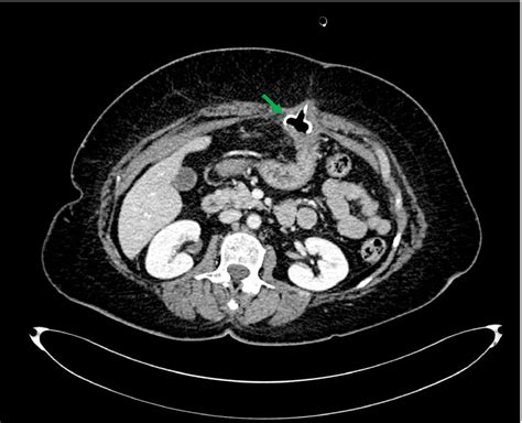 Buried bumper syndrome: A late complication of PEG tube insertion - Mohamad Ali - 2021 ...