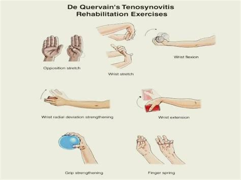 De Quervain Tenosynovitis Exercises Archives - PT Master Guide