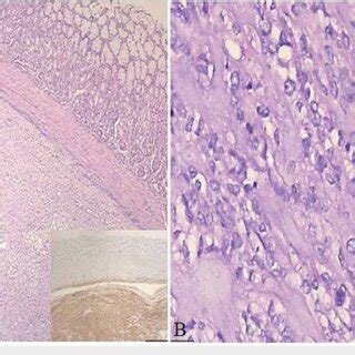 Histopathological image of the gastrointestinal stromal tumor. (A ...