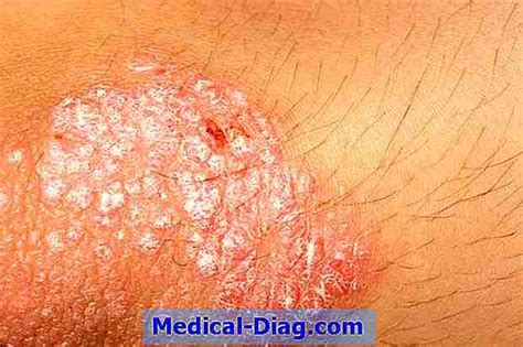 Erytrodermisk Psoriasis: Diagnos, Symptom Och Behandling (Medical-Diag.com 2024)