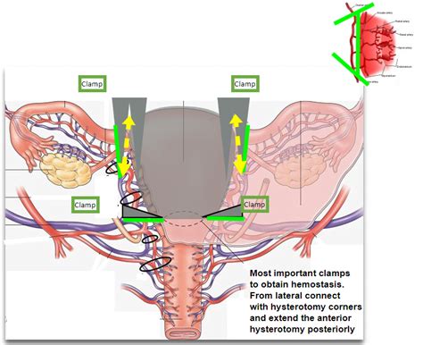 Emergency Peripartum Hysterectomy – Rural Surgery & Obstetrics