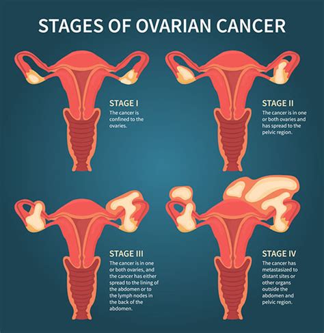 Take Ovarian Cancer Seriously: Risks, Diagnosis, & Treatment - The Woman's Clinic