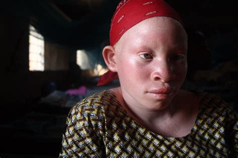 The New Humanitarian | Magic and murder: albinism in Malawi