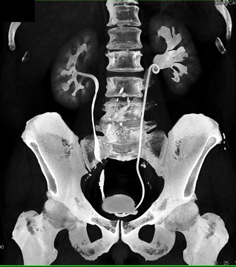 TCC of the Distal Left Ureter - Kidney Case Studies - CTisus CT Scanning