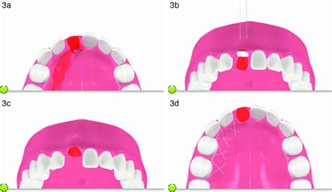 (a) The pedicle graft is released from the bed and rotated over the... | Download Scientific Diagram