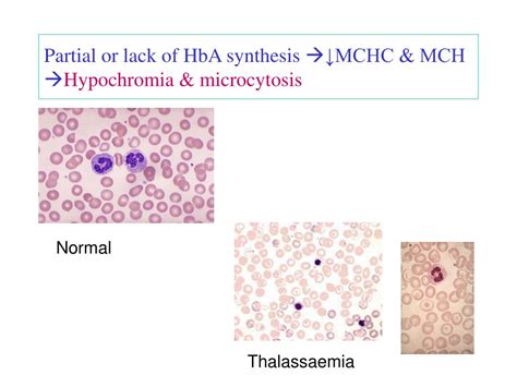 PPT - Thalassaemia: Pathogenesis and Lab Diagnosis PowerPoint Presentation - ID:356186