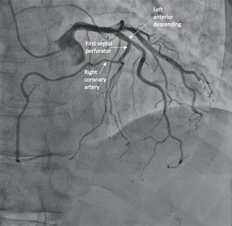 Anomalous Origin of the Right Coronary Artery From the First Septal Perforator | Cureus