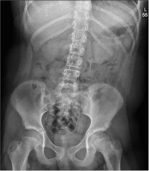 Normal Abdominal X Ray