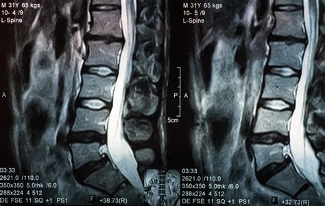 Discectomy Before And After