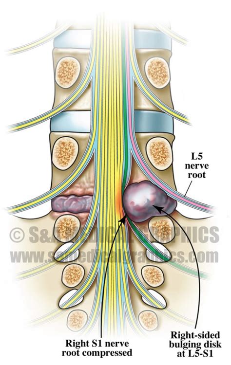 Lumbar Nerve Root Case Study - S&A Medical Graphics