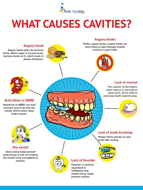 What Causes Cavities? | Dental caries, Sedation dentistry, Dentistry