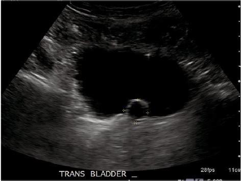 Bladder Cystitis Ultrasound