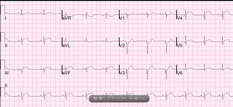 Dr. Smith's ECG Blog: Another STEMI in a Young Person with no CP or SOB: Why We Should Record an ...