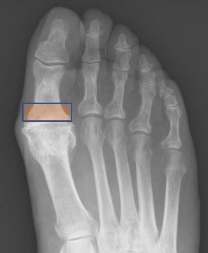 Hallux Rigidus X Ray