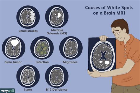 Flecken auf einem MRI: Hyperintensitäten weißer Materie