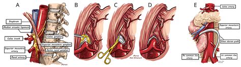 Cureus | Two Decades of Experience With Chronic Mesenteric Ischaemia and Median Arcuate Ligament ...