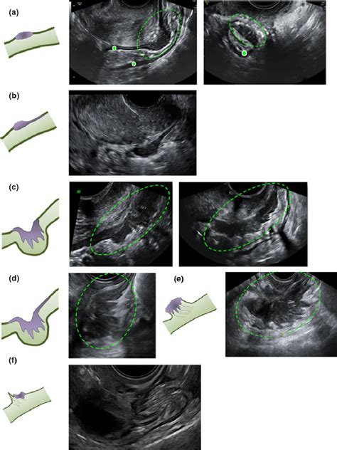 Schematic Drawings and Corresponding Ultrasound Images of Bowel Deep ...