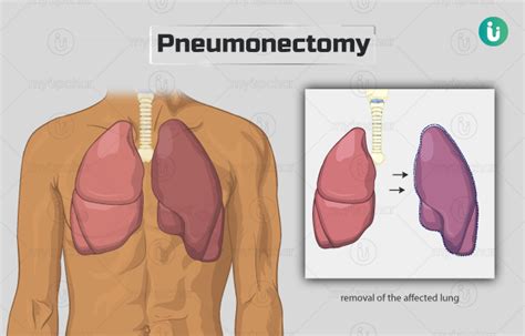 Pneumonectomy: Procedure, Purpose, Results, Cost, Price