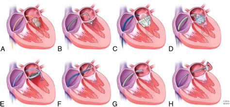 Techniques of transseptal puncture | Thoracic Key